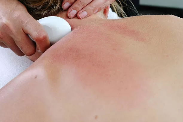 Gua Sha Treatment