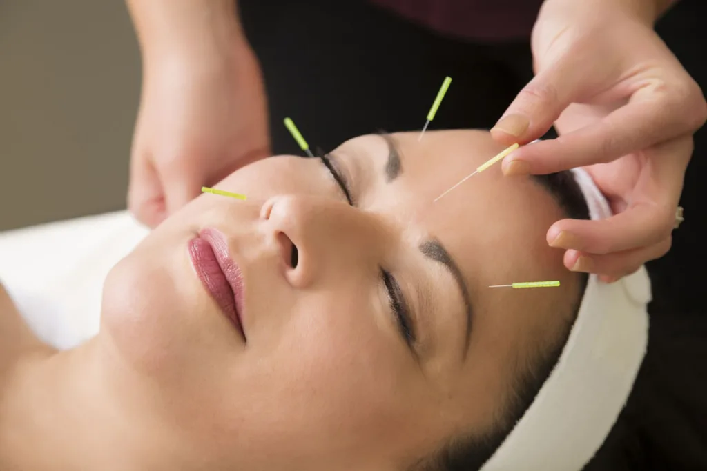 facial acupuncture